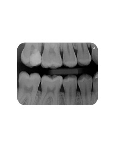 Plaques IQ VistaScan format 0 a 4 — Gamme complete intra-ora