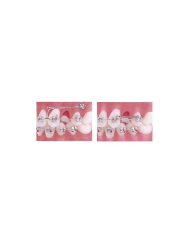 Force medium 150g - 12.0 mm (.011" x .030")